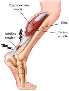 Achilles Tendonitis Artesia | Chronic 
