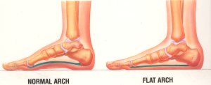 Flat-Feet-1