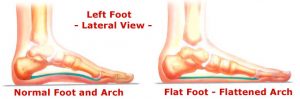 flat-foot-arch