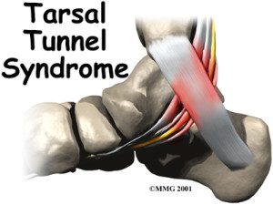 foot_tarsal_tunnel_intro01-300x225